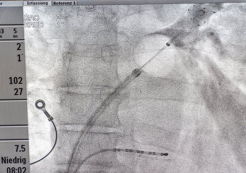 vollständige Abdeckung der Pulmonalvenenmündung in den linken Vorhof durch den Kryoballon