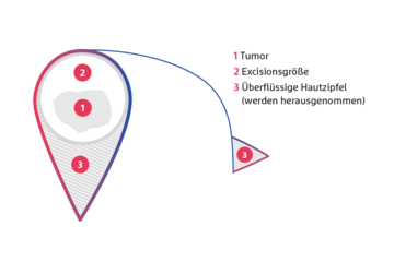 Schematische Darstellung der Nahlappenplastik hier Rotationslappen (Schnitt gebogen)